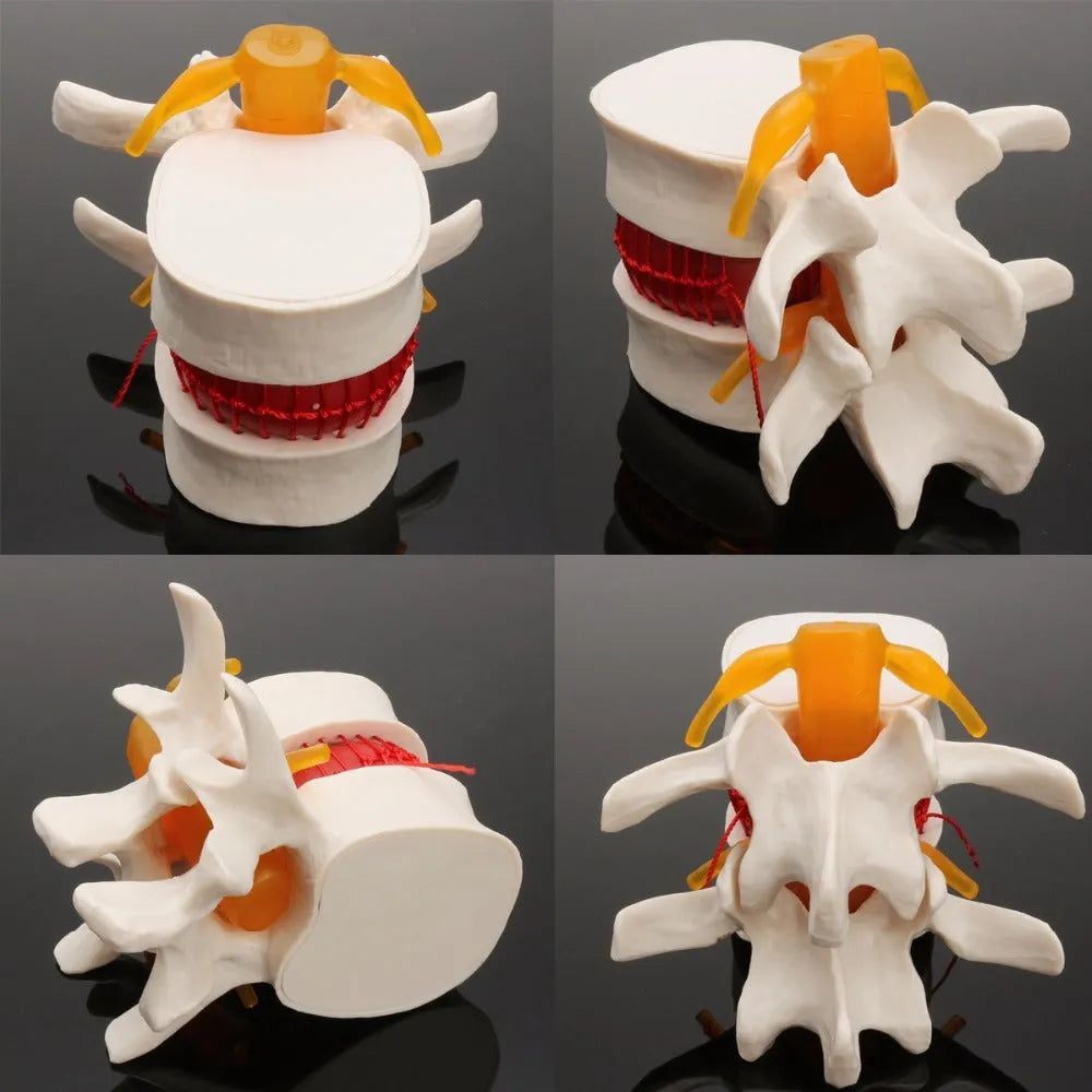 White PVC anatomical model of a human lumbar intervertebral disc for medical demonstration.